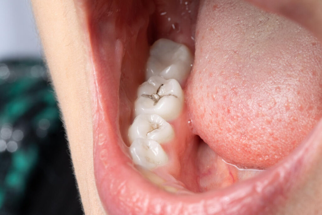 Dental Fillings