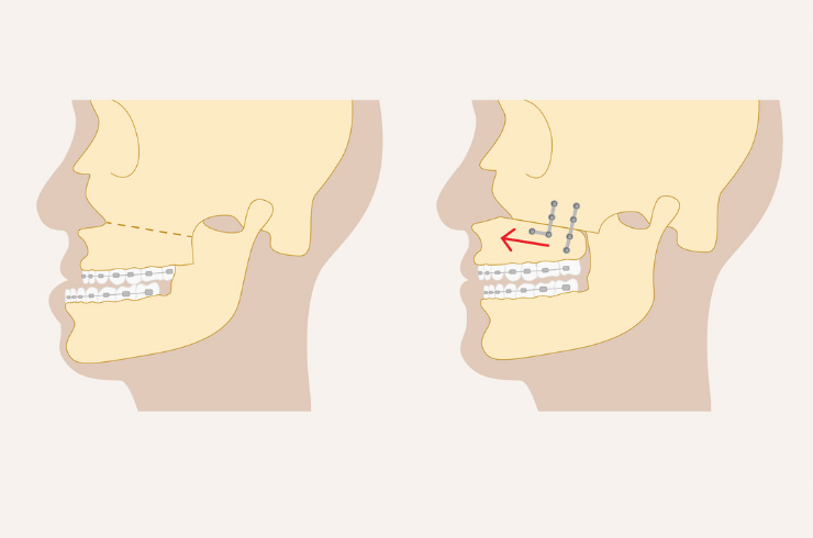 Jaw Surgery